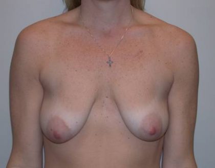 Breast Lift/Reduction Before & After Patient #7297