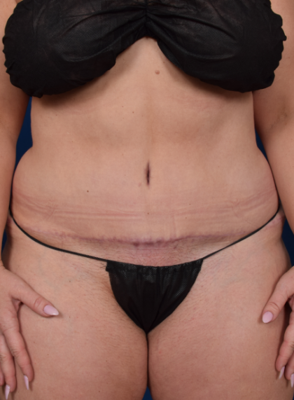 Standard Liposuction Before & After Patient #7378