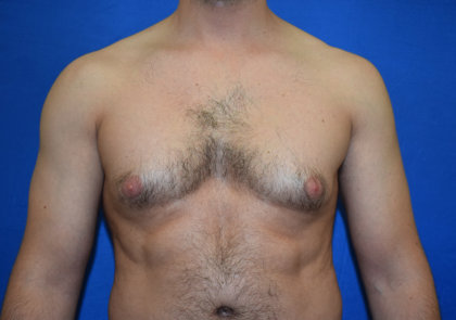 Gynecomastia Before & After Patient #7377