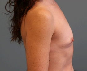 Breast Augmentation Before & After Patient #7264