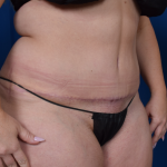 Standard Liposuction Before & After Patient #7378