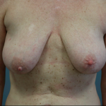 Breast Lift/Reduction Before & After Patient #7298
