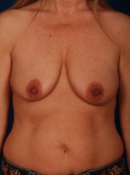 Breast Lift/Reduction Before & After Patient #7263