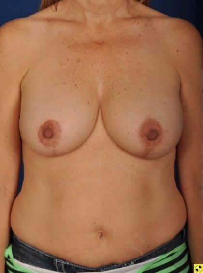 Breast Lift/Reduction Before & After Patient #7263