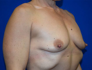 Breast Augmentation Before & After Patient #7485