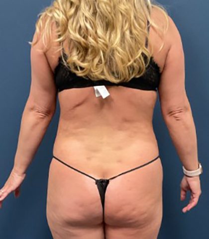 Standard Liposuction Before & After Patient #7496