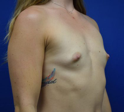 Breast Augmentation Before & After Patient #7474