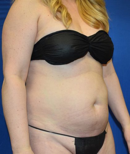 Standard Liposuction Before & After Patient #7496
