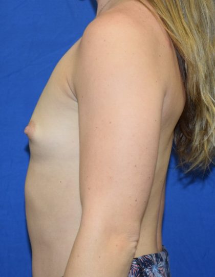 Breast Augmentation Before & After Patient #7474