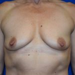 Breast Augmentation Before & After Patient #7485