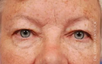 Brow Lift Before & After Patient #7738