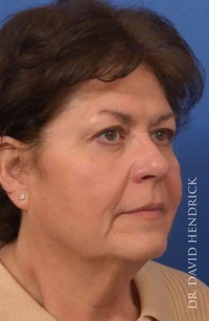 Brow Lift Before & After Patient #7785