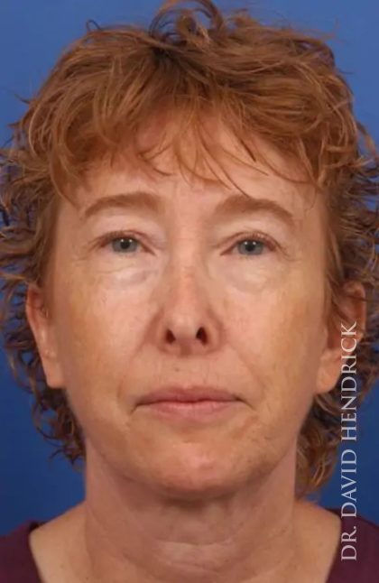 Brow Lift Before & After Patient #7795