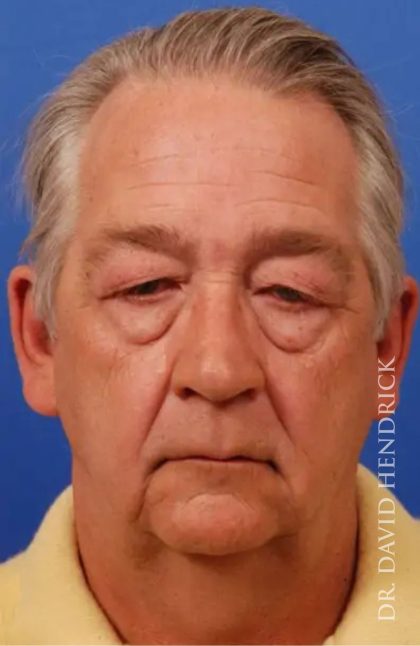 Brow Lift Before & After Patient #7800