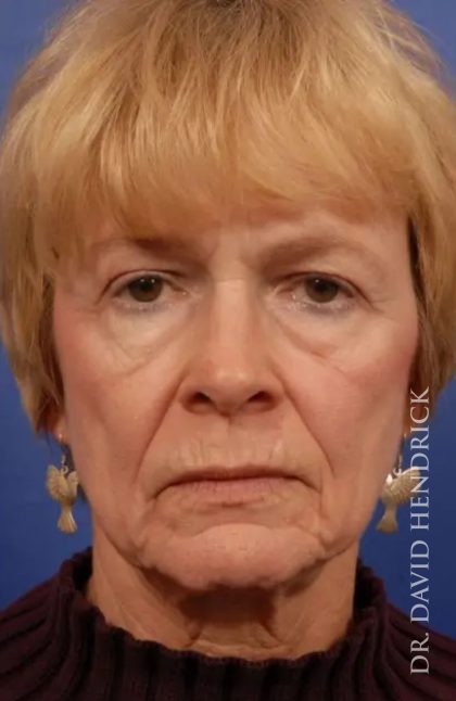 Facelift Before & After Patient #7803