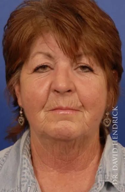 Facelift Before & After Patient #7813