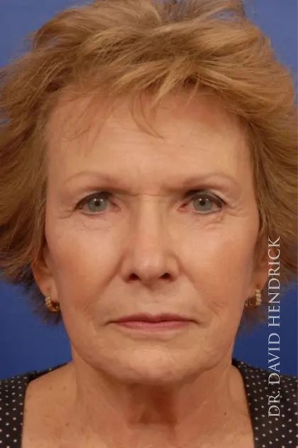 Facelift Before & After Patient #7818