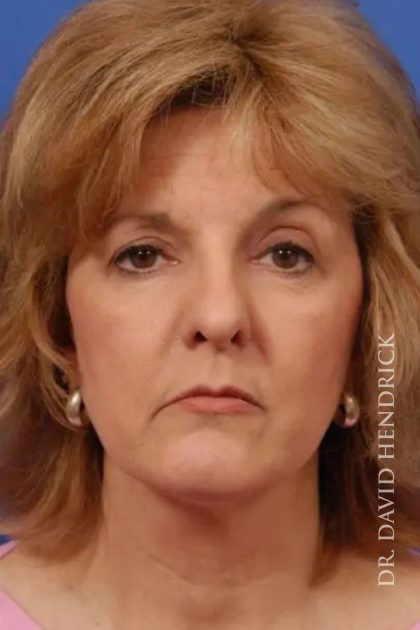 Facelift Before & After Patient #7825