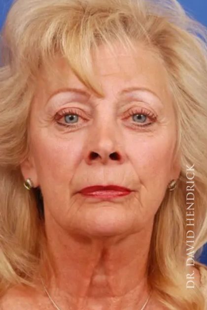 Facelift Before & After Patient #7845