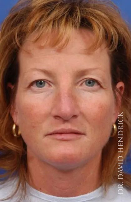 Brow Lift Before & After Patient #7743