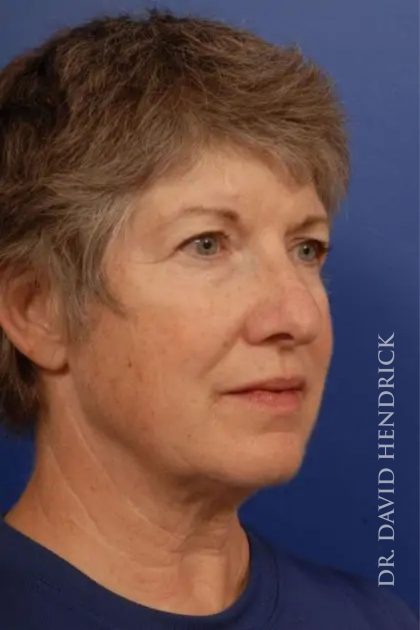 Facelift Before & After Patient #7850