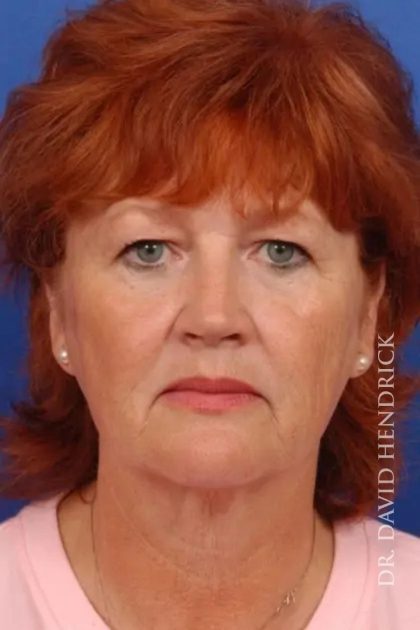 Blepharoplasty Before & After Patient #7860