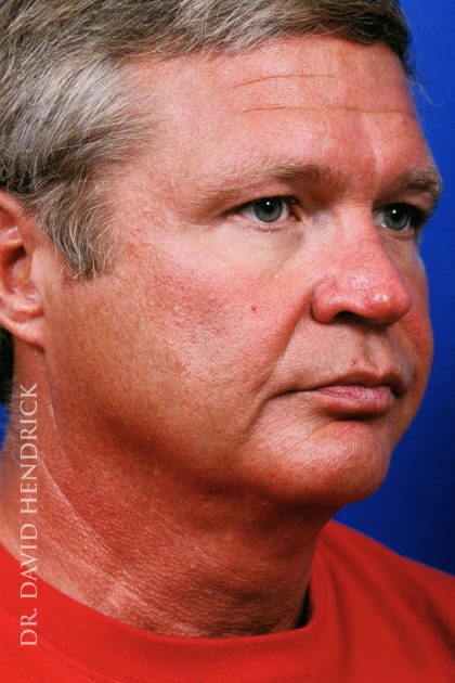 Facelift Before & After Patient #7839