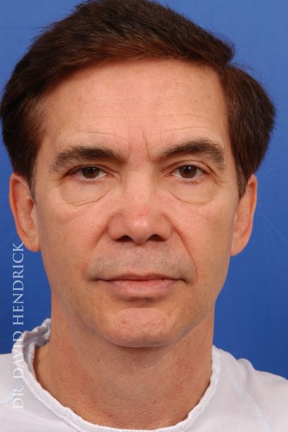 Facelift Before & After Patient #7830