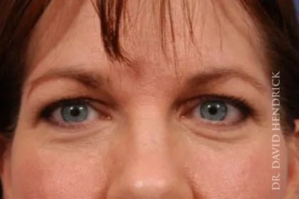 Brow Lift Before & After Patient #7782