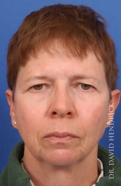 Brow Lift Before & After Patient #7748