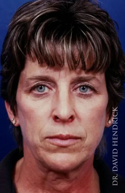 Brow Lift Before & After Patient #7753