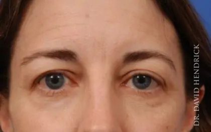 Brow Lift Before & After Patient #7733