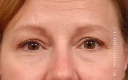 Brow Lift Before & After Patient #7758