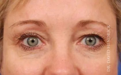 Brow Lift Before & After Patient #7766