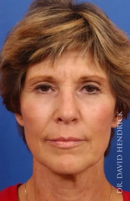 Brow Lift Before & After Patient #7769