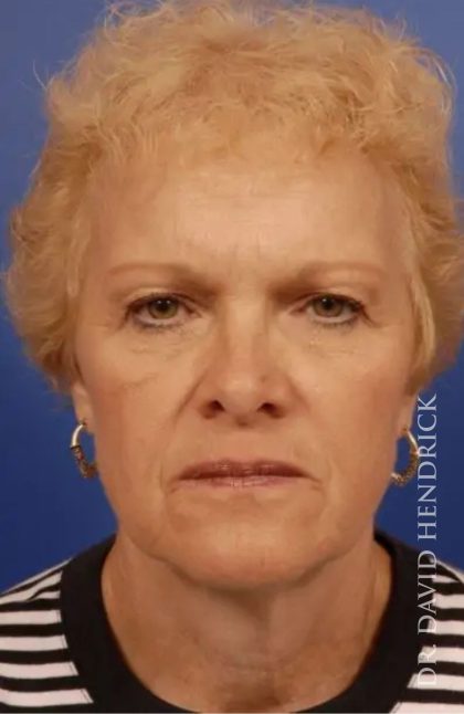 Brow Lift Before & After Patient #7774
