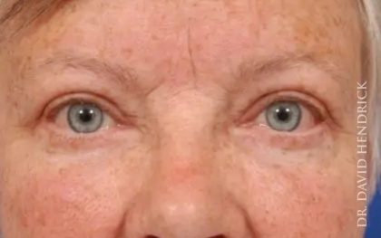 Brow Lift Before & After Patient #7738