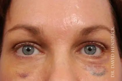 Brow Lift Before & After Patient #7779