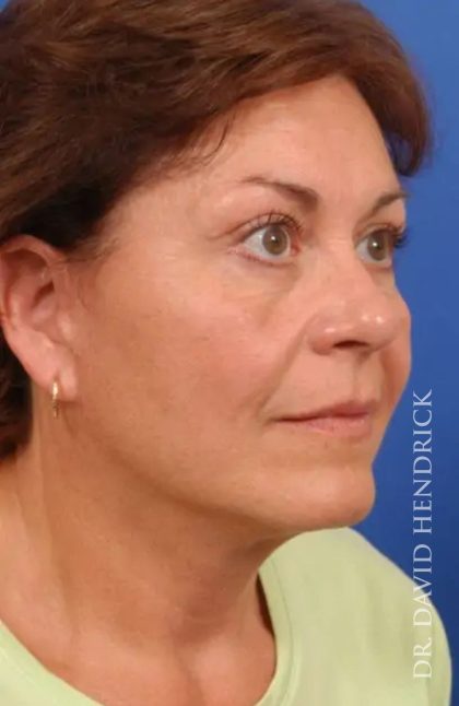 Brow Lift Before & After Patient #7785