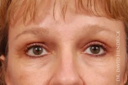 Brow Lift Before & After Patient #7790