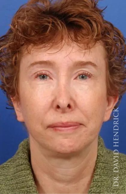 Brow Lift Before & After Patient #7795