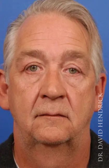 Brow Lift Before & After Patient #7800