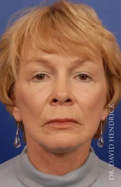 Facelift Before & After Patient #7803
