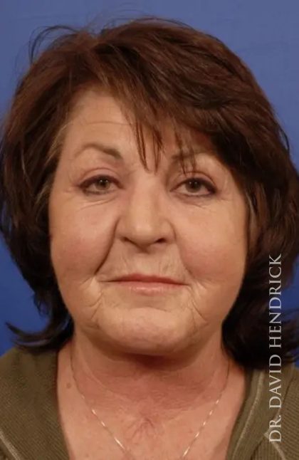 Facelift Before & After Patient #7813