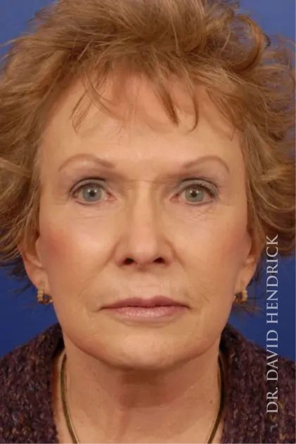 Facelift Before & After Patient #7818