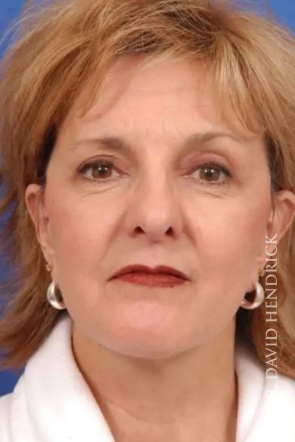 Facelift Before & After Patient #7825