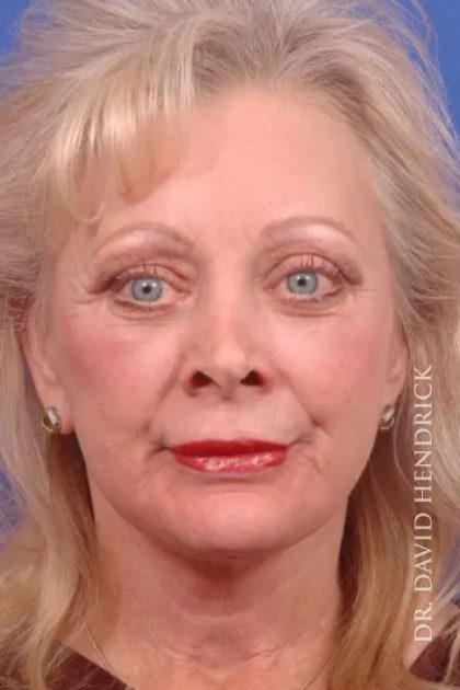 Facelift Before & After Patient #7845