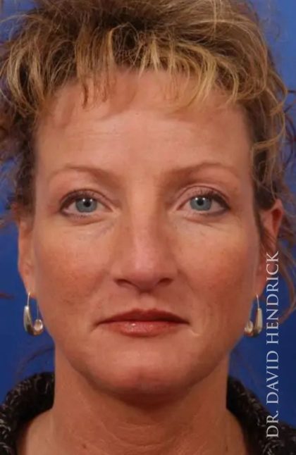 Brow Lift Before & After Patient #7743