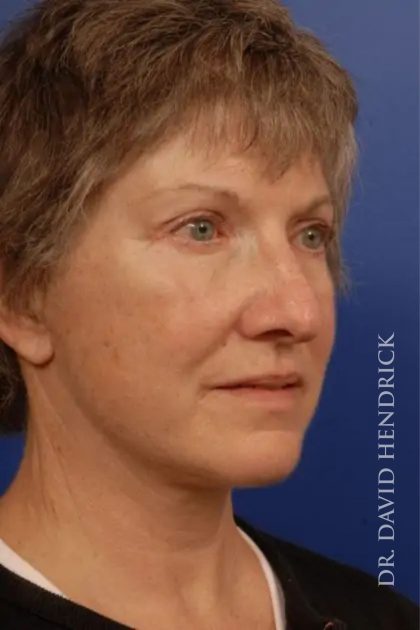 Facelift Before & After Patient #7850