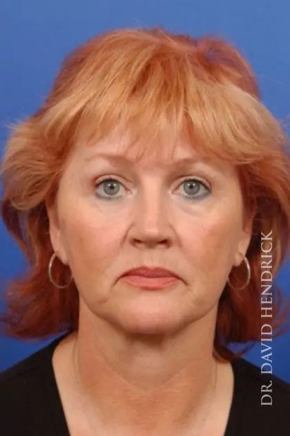 Blepharoplasty Before & After Patient #7860